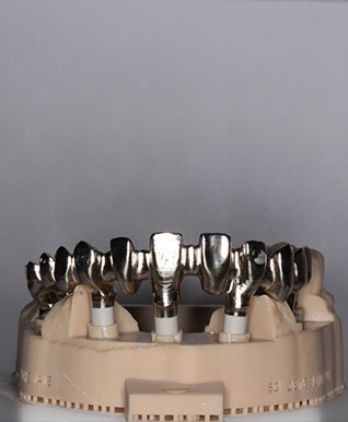 dental implants united kindom